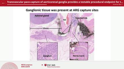 Transvascular pace-capture of aorticorenal ganglia provides a testable procedural endpoint for transcatheter renal artery denervation and identifies a novel therapeutic ablation target for denervation