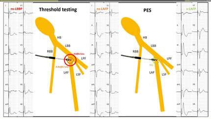 Double-Transition from Non-selective Left-bundle Branch Pacing to Selective Left Anterior Fascicular Pacing