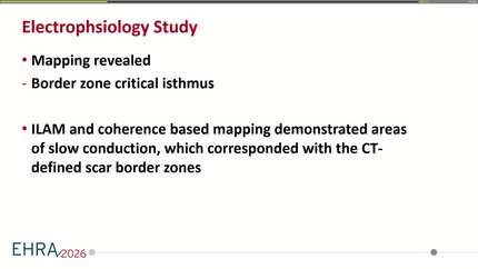 Complex arrhythmias