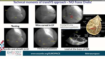 Left ventriclar endocardial pacing: novel transmyocardial approaches