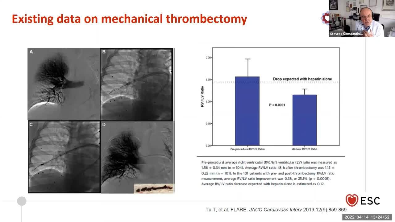 ACVC Talks - Acute PE - 
Risk stratification and risk-adapted treatment of PE - what does it mean for clinical practice?
