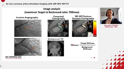 In vivo coronary artery thrombus imaging with 18F-GP1 PET-CT 