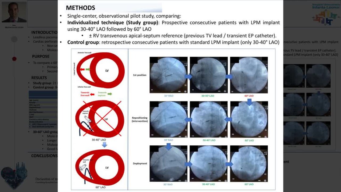 ESC 365 - Extreme left anterior oblique projection guided leadless ...