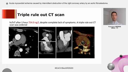 Acute myocardial ischemia caused by intermittent obstruction of the right coronary artery by an aortic fibroelastoma.