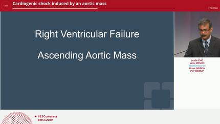 Cardiogenic shock induced by an aortic mass