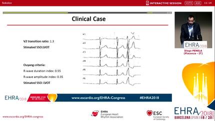 Predictors of ablation success: any role of the surface ECG?