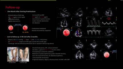 Systemic sarcoidosis with musculoskeletal and cardiac involvement