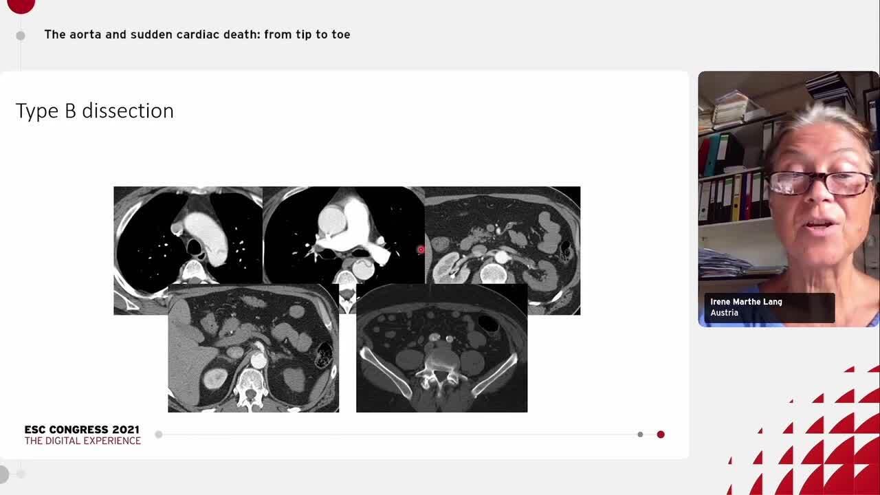 Early recognition of acute aortic syndromes: diagnostic pitfalls and traps.