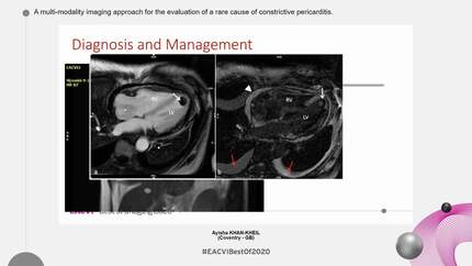 A multi-modality imaging approach for the evaluation of a rare cause of constrictive pericarditis.