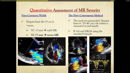 Role of echocardiography in the management ischemic mitral regurgitation.