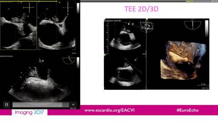 Straddling atrial thrombus associated with pulmonary embolism and acute coronary syndrome
