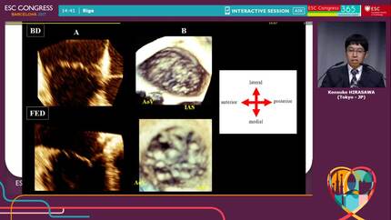 Tricuspid valve geometry in patients with Barlow type mitral valve prolapse: a three-dimensional transesophageal echocardiography study.