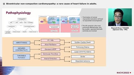 Biventricular non-compaction cardiomyopathy: a rare cause of heart failure in adults.
