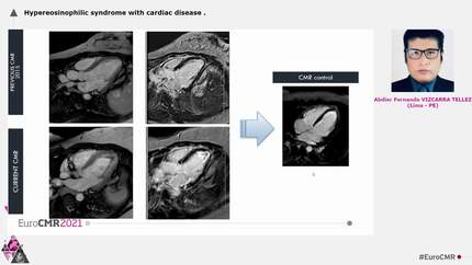 Hypereosinophilic syndrome with cardiac disease
.