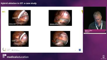 Hybrid ablation: atrial fibrillation and beyond