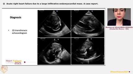 Acute right heart failure due to a large infiltrative endomyocardial mass. A case report.