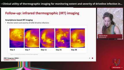 Clinical utility of thermographic imaging for monitoring extent and severity of driveline infection in left-ventricular-assist device patients