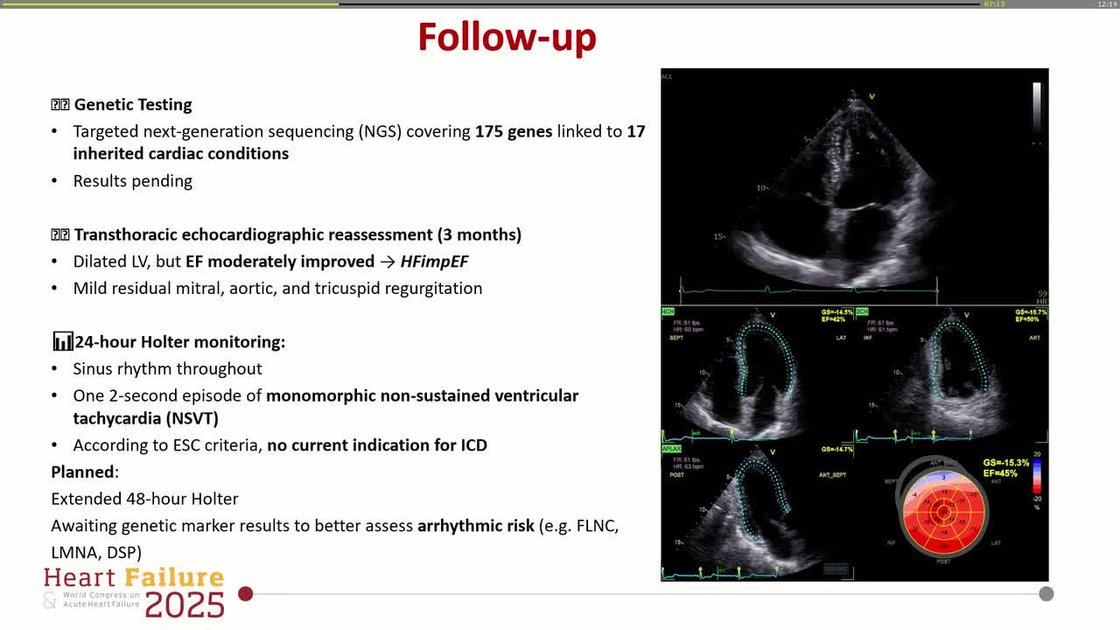 ESC 365 - Post-myocarditis dilated cardiomyopathy with left ventricular ...