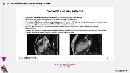 An unusual storage cardiomyopathy disease.