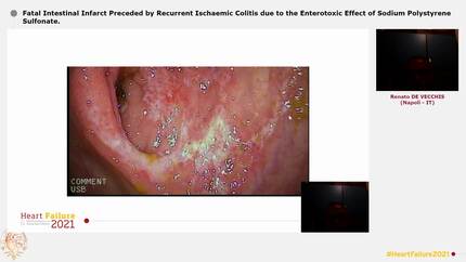 Fatal Intestinal Infarct Preceded by Recurrent Ischaemic Colitis due to the Enterotoxic Effect of Sodium Polystyrene Sulfonate.