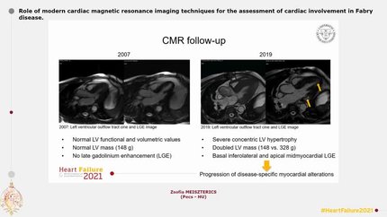Role of modern cardiac magnetic resonance imaging techniques for the assessment of cardiac involvement in Fabry disease.