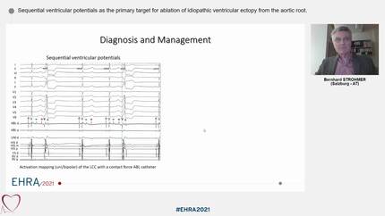 Sequential ventricular potentials as the primary target for ablation of idiopathic ventricular ectopy from the aortic root.