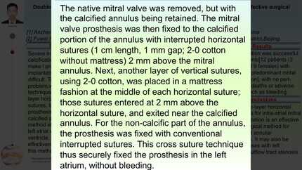 Double-layer horizontal cross sutures for intra-atrial mitral valve implantation is an effective surgical method for severe mitral annular calcification