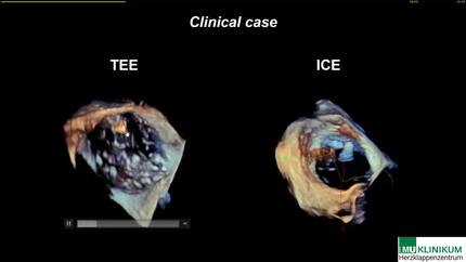 3D ICE & TEE imaging: partners or enemies