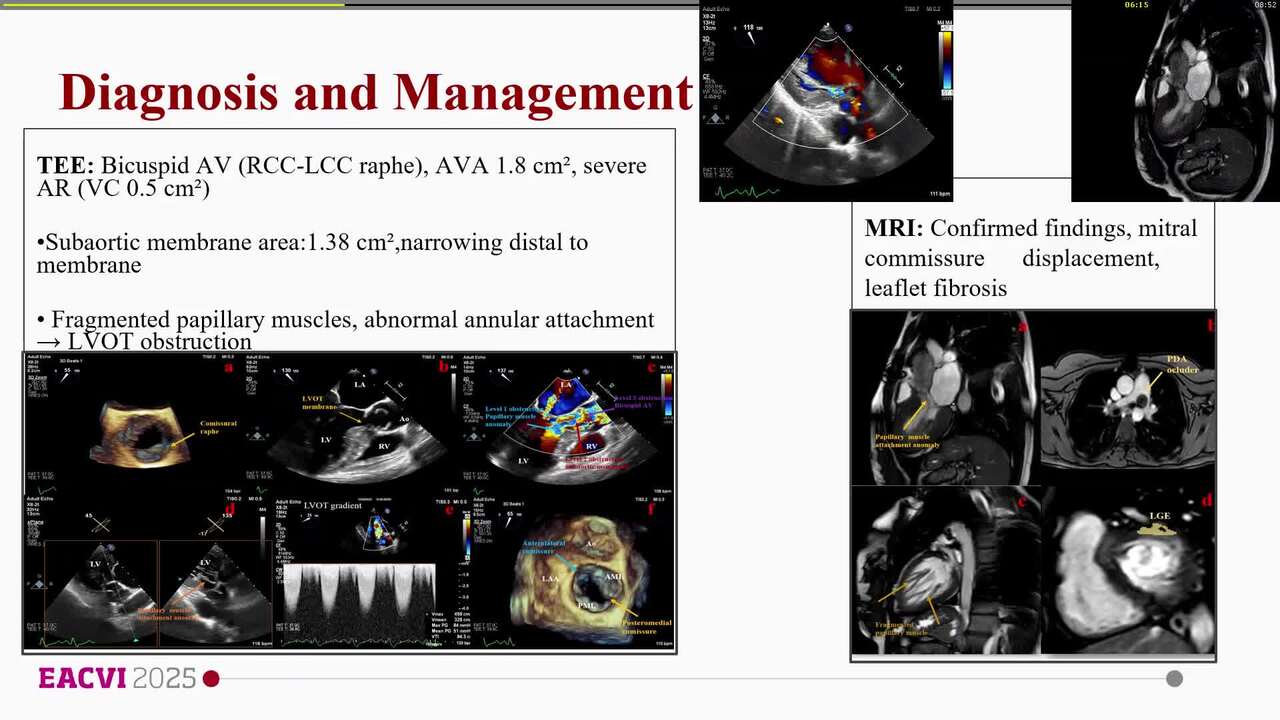 Congenital heart disease: when we need more than one!