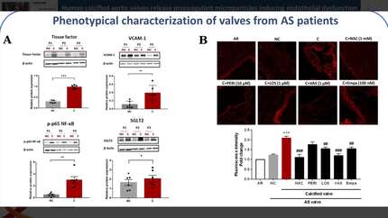 Human calcified aortic valves release procoagulant microparticles inducing endothelial dysfunction and thrombogenicity: Role of the AT1R/NADPH oxidases/SGLT2 pro-oxidant pathway