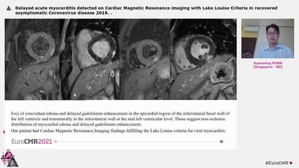 Delayed acute myocarditis detected on Cardiac Magnetic Resonance imaging with Lake Louise Criteria in recovered asymptomatic Coronavirus disease 2019.
.