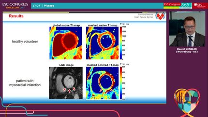 Selective TRASSI T1 mapping for improved endocardial and right ventricular diagnostics