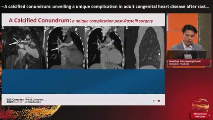A calcified conundrum: unveiling a unique complication in adult congenital heart disease after rastelli surgery