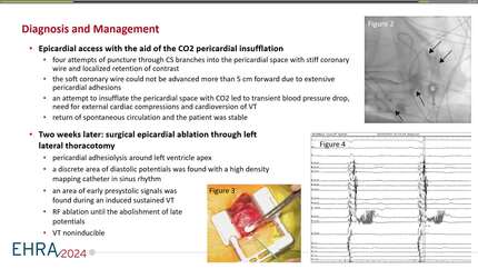 Successful ablation of ventricular tachycardia with lateral thoracotomy in a patient with left ventricular thrombus and pericardial adhesions: a case report