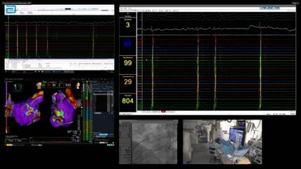 Live case session - atrial reentrant tachycardia: how to tackle all the atypical stuff!