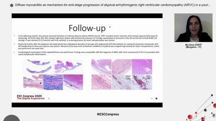 Diffuse myocarditis as mechanism for end-stage progression of atypical arrhythmogenic right ventricular cardiomyopathy (ARVC) in a young lady undergoing heart transplantation (HT).