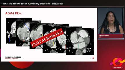 What we need to see in pulmonary embolism – discussion.