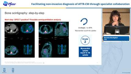 Heart failure and ATTR-CM: recognizing an underdiagnosed condition