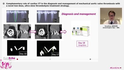 Complementary role of cardiac CT in the diagnosis and management of mechanical aortic valve thrombosis with a novel low-dose, ultra-slow thrombolysis treatment strategy.
