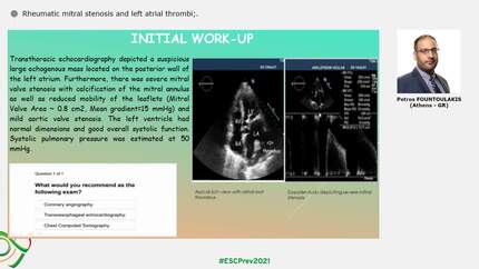 Rheumatic mitral stenosis and left atrial thrombi;.