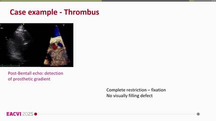 Cardiac CT to evaluate prosthetic valve thrombus and pannus