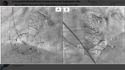 X-ray guided left bundle branch area pacing lead implantation after transcatheter tricuspid valve replacement is feasible and safe 