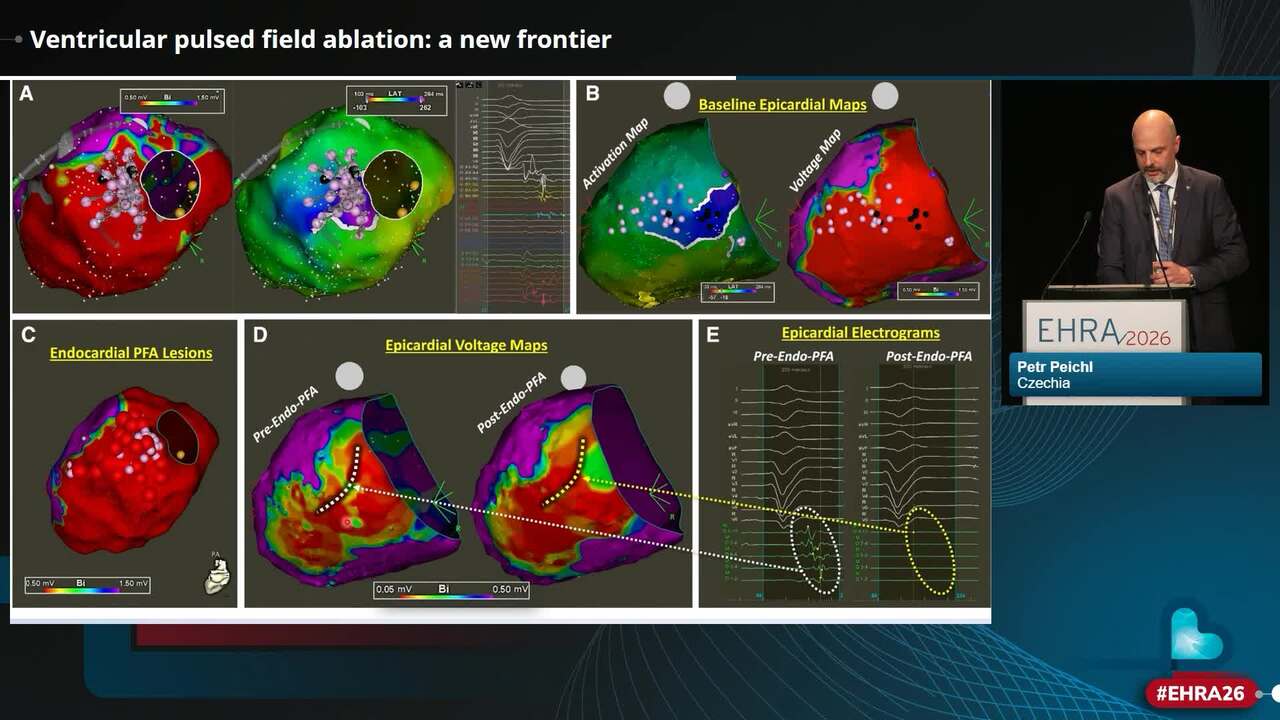 Ventricular pulsed field ablation: a new frontier