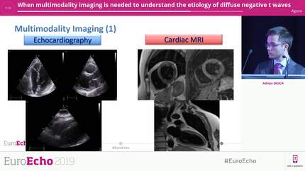 When multimodality imaging is needed to understand the etiology of diffuse negative t waves