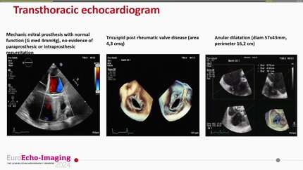 Valvular heart disease 3