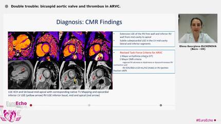 Double trouble: bicuspid aortic valve and thrombus in ARVC.