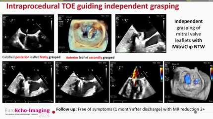 Calcium is not an issue for transcatheter mitral valve therapy. Role of independent leaflet grasping