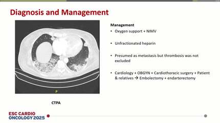 Intracardiac mass and pulmonary embolism in a patient with endometrial sarcoma: Thromboembolism or tumor embolism?