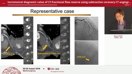 Incremental diagnostic value of CT-fractional flow reserve using subtraction coronary CT angiography for patients with severe calcification
