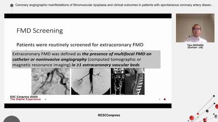 Coronary angiographic manifestations of fibromuscular dysplasia and clinical outcomes in patients with spontaneous coronary artery dissection